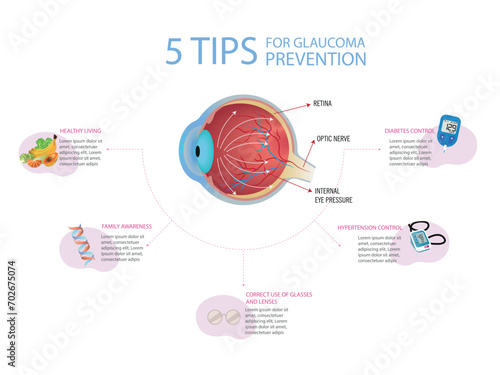 5 tips for glaucoma prevention. Diagram of an eye with glaucoma on white background and surrounded by 5 tips for prevention.
