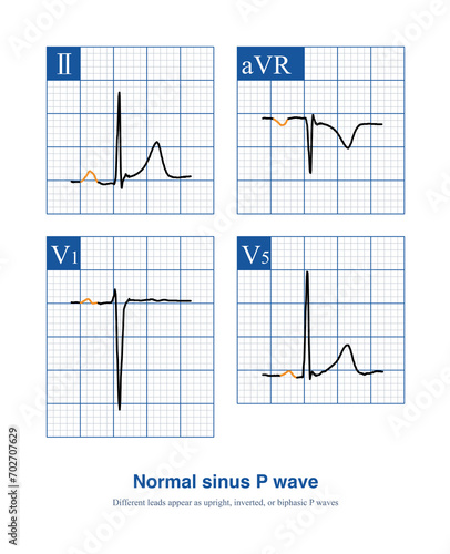 Normal sinus P waves, which may appear as upright, inverted, or biphasic in different leads, depend on the direction of atrial exaltation and the lead axis. photo