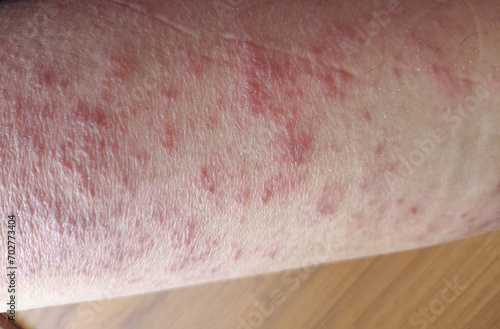 rash eczema dermatitis  on leg. inflammation of skin
