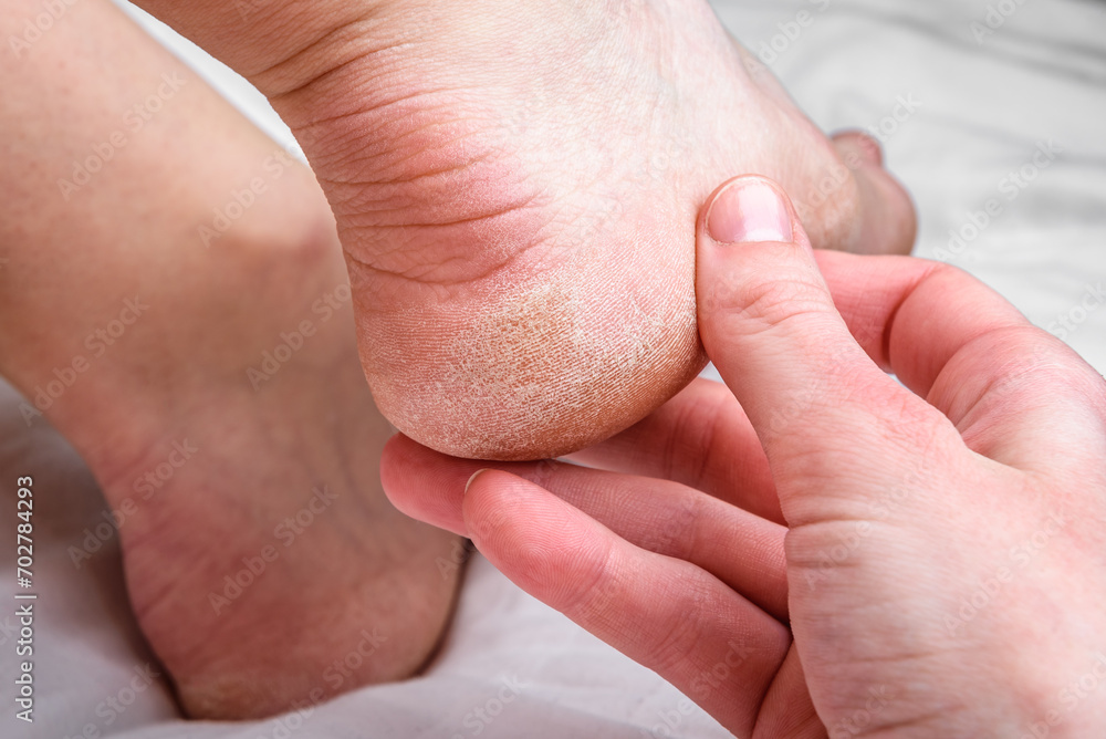 Dry skin on heel is cracked. Dehydrated skin on heels of female feet. Dry skin on heel is cracked. Dehydrated skin on heels of female feet.
