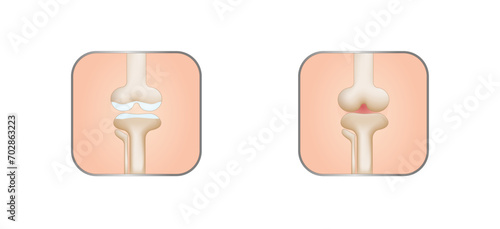 Osteoarthritis. Healthy and Arthritis knee joint. Knee pain. Vector illustration.