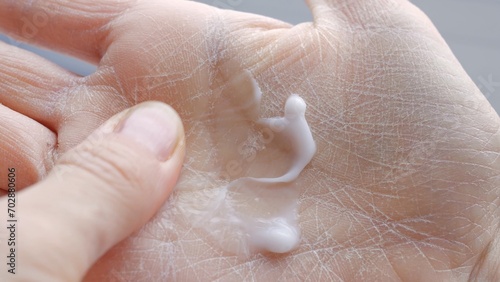 Canvas Print Using hand cream for dry skin close-up moisturizing palms and treating dermatiti