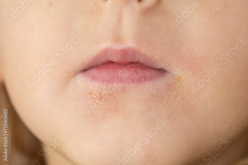 Little boy with dry skin on face, closeup