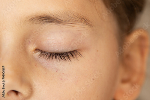 Little child with small red dots or petechia on the face under the eyes