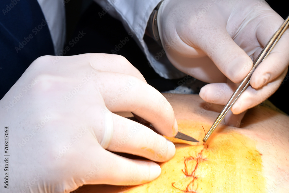 The surgeon s hands at the moment of removing the suture threads on the patient s abdomen. The surgeon s hands at the moment of removing the suture threads on the patient s abdomen.