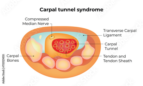 Carpal Tunnel Syndrome Science Design Vector Illustration Diagram