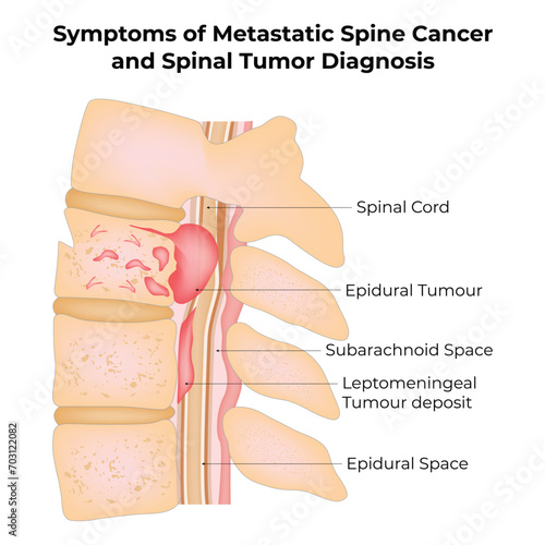 Symptoms of Metastatic Spine Cancer and Spinal Tumor Diagnosis Science Design Vector Illustration