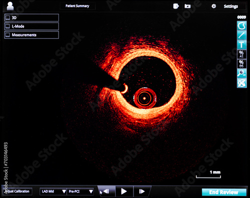 optical coherence tomography oct image angiography catheter lab atherosclerosis, computer screen image photo
