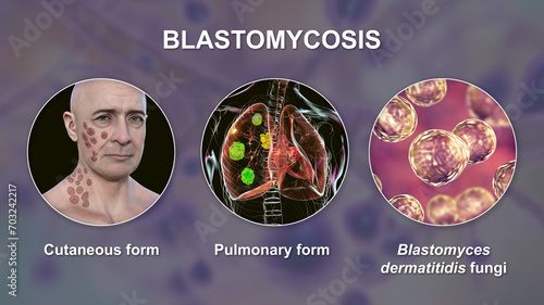 Clinical forms of blastomycosis, 3D illustration photo