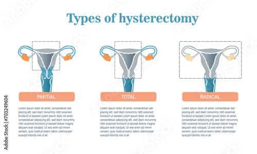 Infographic on the types of hysterectomy surgery in the treatment of endometriosis.