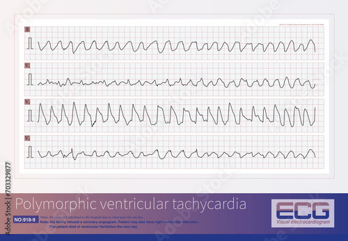 Male, 84 years old, admitted to hospital with chest pain for 1 day. ECG showed acute inferior and posterior MI and possibly right MI. The patient died of ventricular fibrillation the next day.