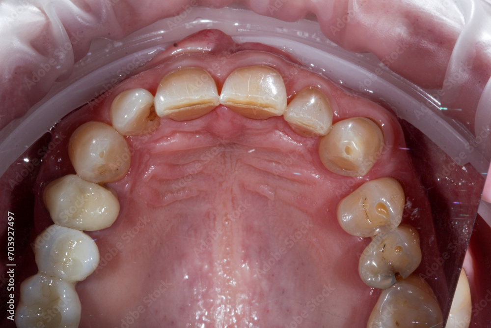 Obraz premium Dentistry. Human open mouth with dental decay