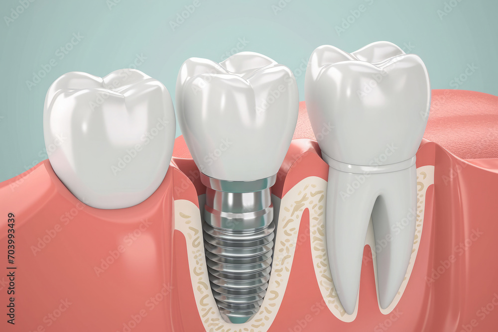 Cross section of the jaw with an embedded dental implant in the gum. Dental surgery for teeth restoration. Dentistry and tooth care concept