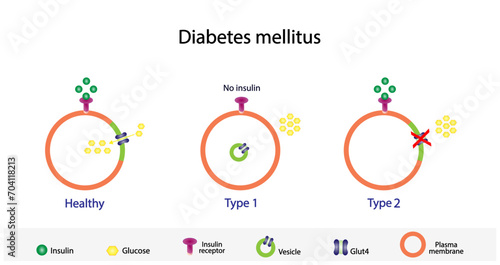 Diabetes mellitus type 1, pancreas's failure to produce enough insulin and type 2, cells fail to respond to insulin (Insulin resistance). Result in high blood glucose levels. Vector illustration.