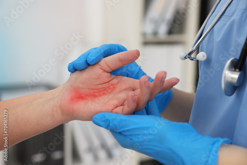 Doctor examining patient's burned hand in hospital, closeup © New Africa