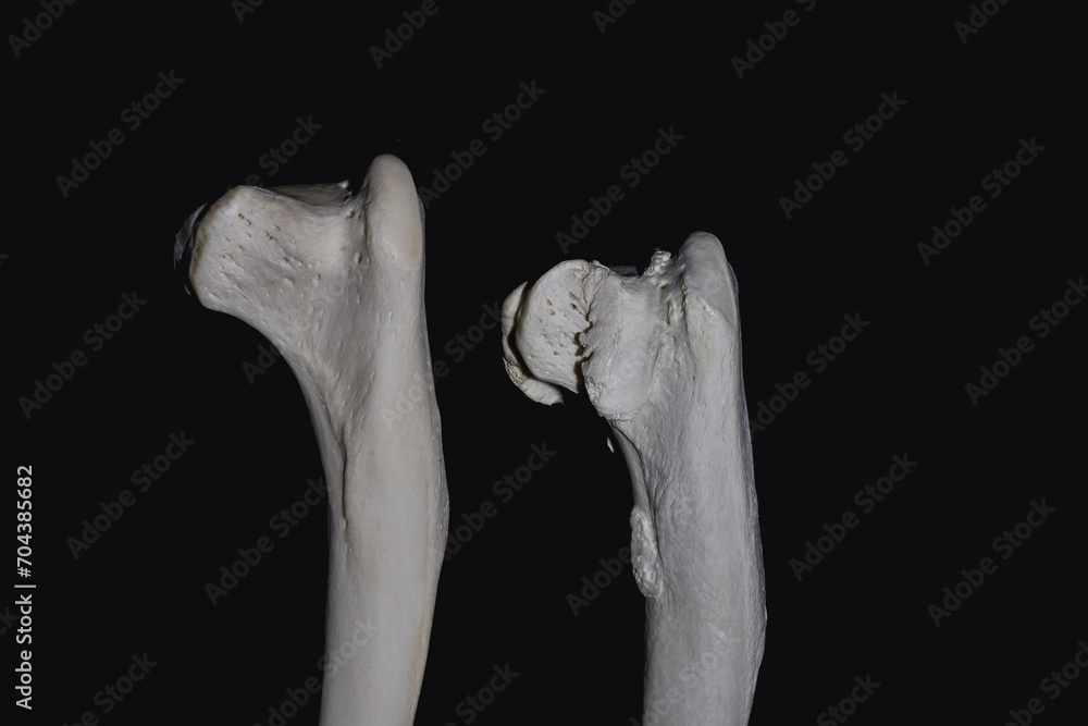 Exostosis on bones Exostosis on bones