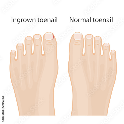 illustration of healthy feet, feet with ingrown toenails, treatment of ingrown toe and toe