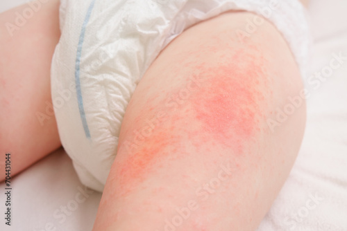 Allergic rash on the legs of the toddler baby boy. Red pimples from allergies on the child's body.