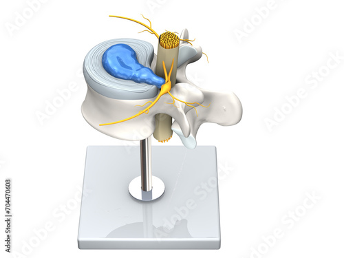 Model of a herniated disc of the lumbar spine, stenosis, slipped disc. 3D Illustration photo