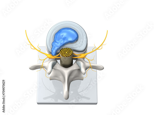 Model of a herniated disc of the lumbar spine, stenosis, slipped disc. 3D Illustration