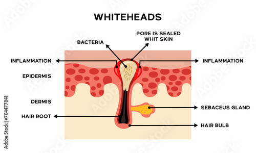 Illustration of the anatomy of whitehead skin along with an explanation of the names of each part photo