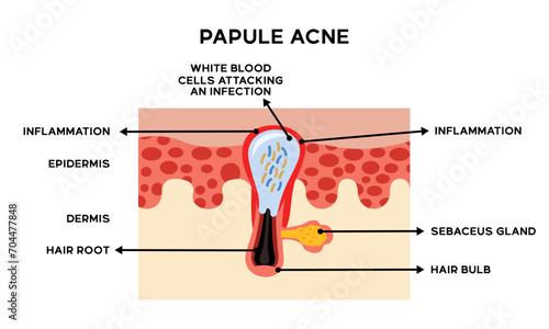 Illustration of the anatomy of papule acne skin along with an explanation of the names of each part