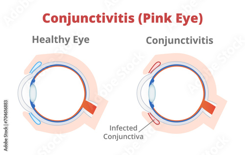 Vector illustration of healthy human eye and conjunctivitis or pink eye isolated on a white background. Viral or bacterial conjunctivitis with inflammation. Healthcare, eye disease, vertical section.