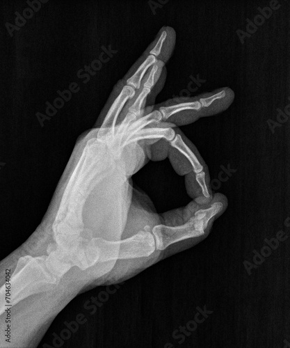 Film xray x-ray or radiograph of a thumb and finger circle associated with ok, agreement, approval, confirmation or positivity in gestural language, manual communication, or signing aka sign language