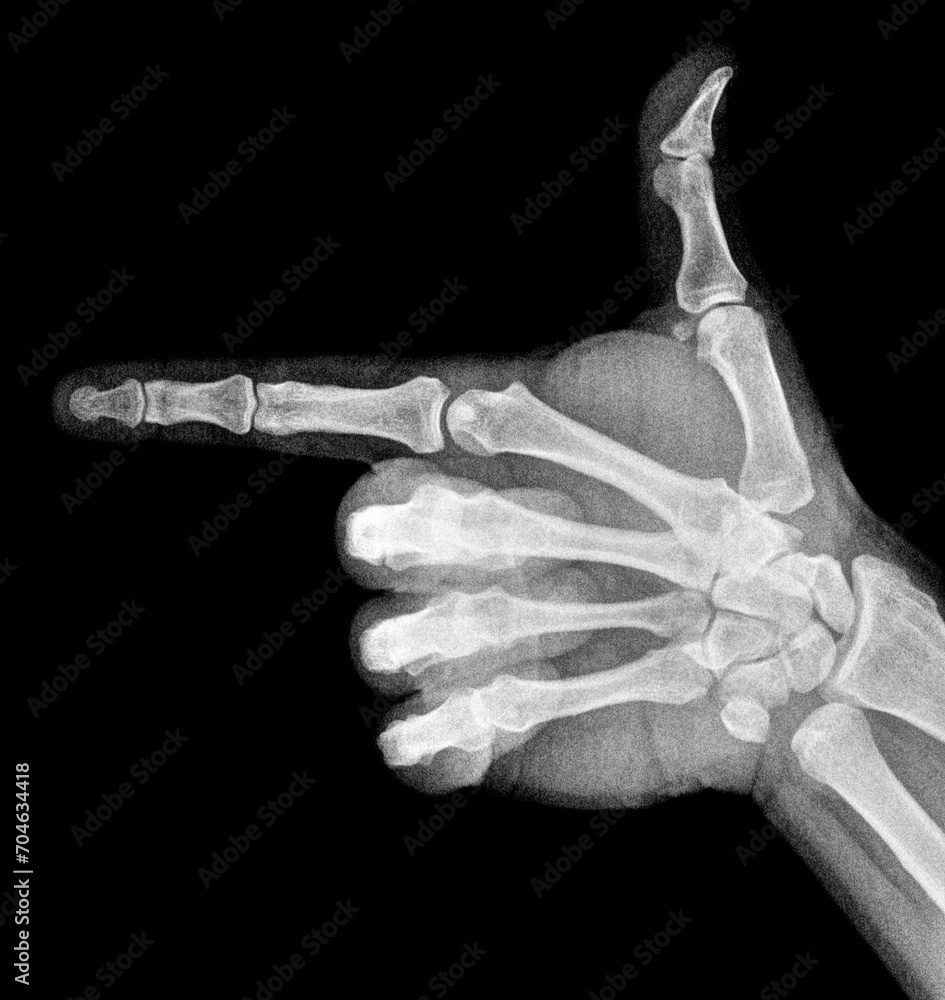 Film xray xray or radiograph of a thumb and finger in gestural