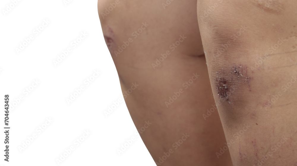 Knees and Legs with Fresh Wounds, Injuries from Blows or Falls, on Isolated Background. Knees and Legs with Fresh Wounds, Injuries from Blows or Falls, on Isolated Background.