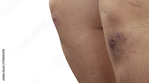 Knees and Legs with Fresh Wounds, Injuries from Blows or Falls, on Isolated Background.