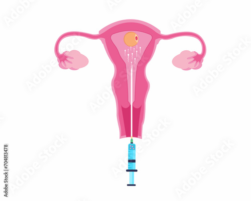 Infertility treatment using Artificial fertilization Human Reproductive technology vector illustration.