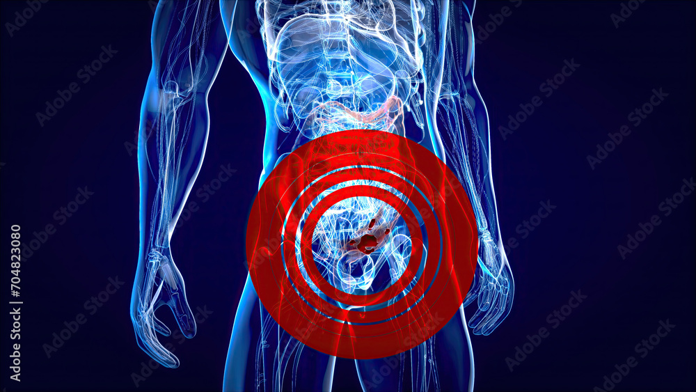 Abstract illustration of the colon cancer - obrazy, fototapety, plakaty 