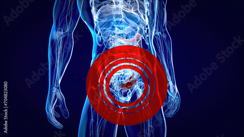 Abstract illustration of the colon cancer photo