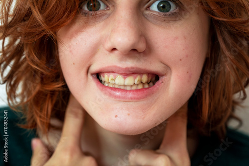 teenage girl wipes droplets from her nose after sneezing