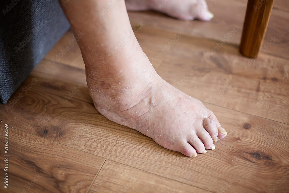Detailed view of an elderly woman's foot, highlighting age-related conditions such as nail and skin disease, vascular problems, age-related changes, and visible swelling. Detailed view of an elderly woman's foot, highlighting age-related conditions such as nail and skin disease, vascular problems, age-related changes, and visible swelling.