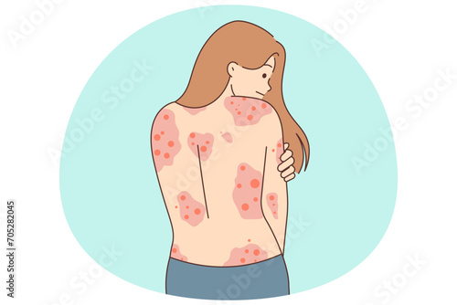 Unhealthy woman show red rash on back