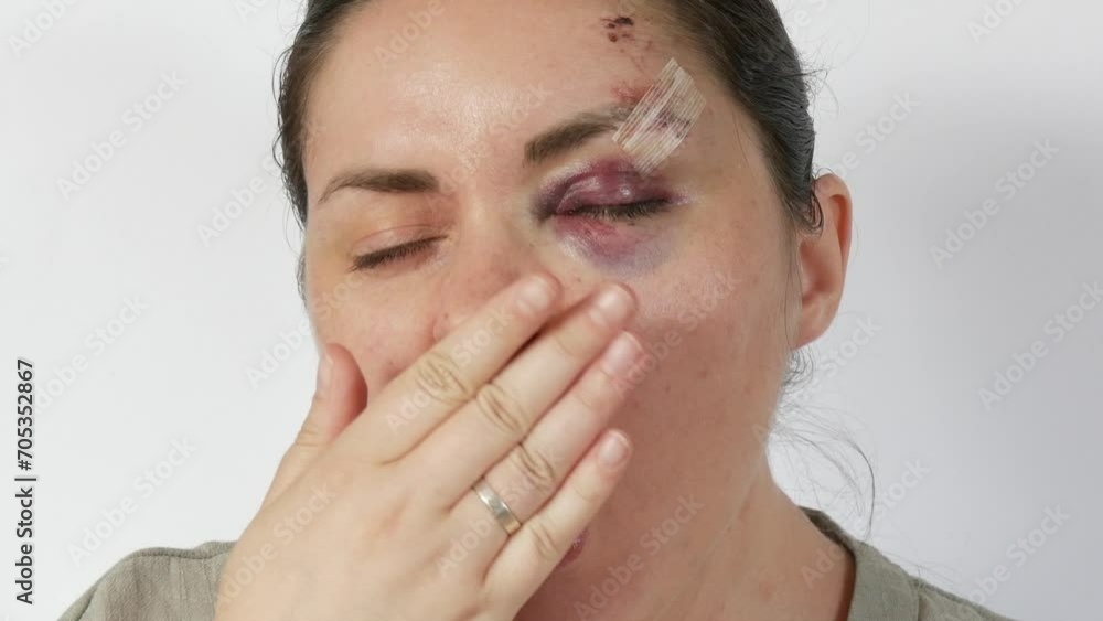 Young woman yawns at the camera with real bruise hematoma under eye of