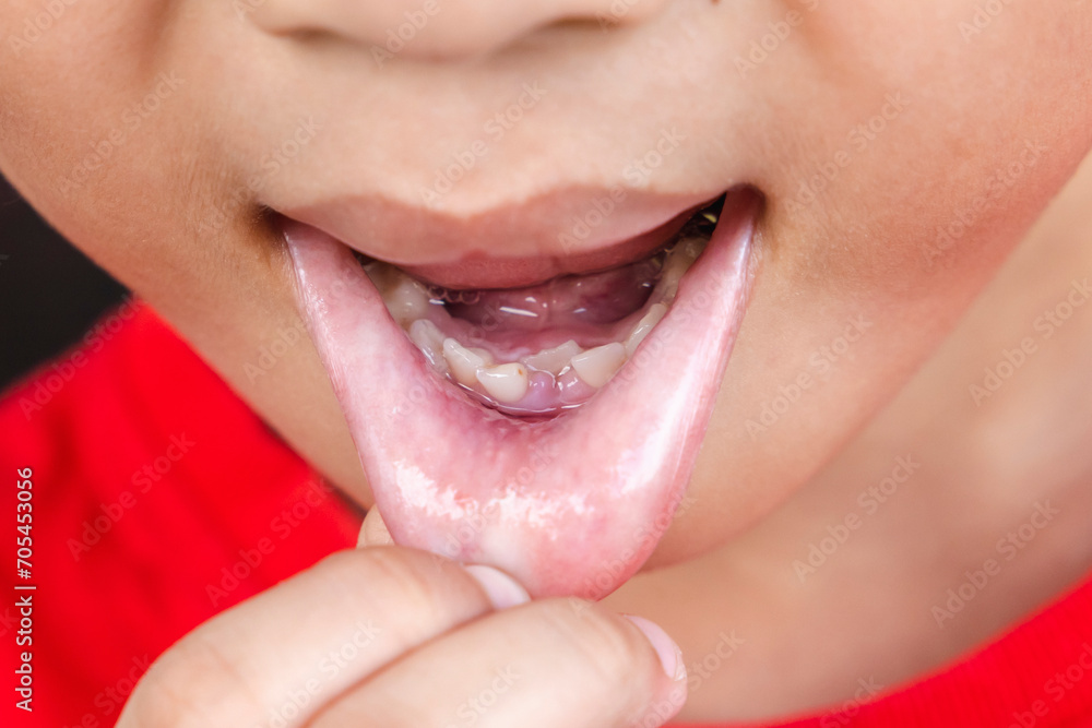 child-milk-teeth-fall-out-from-gum-little-boy-permanent-tooth-grows-in