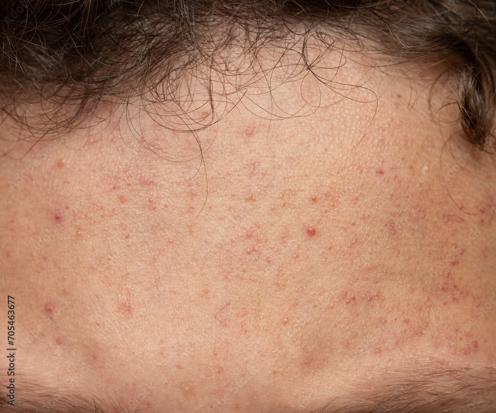 Fototapeta premium allergic red rash on the face.