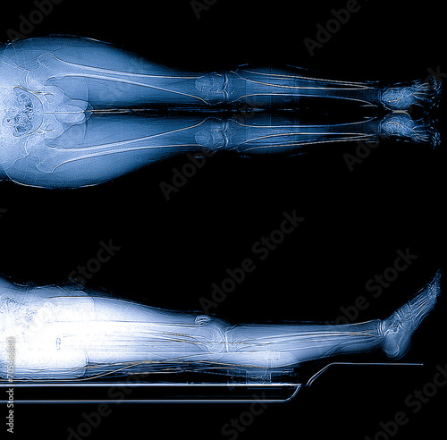 Scanogram is a Full-length standing AP radiograph of both lower extremities including the hip, knee, and ankle photo