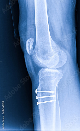 X-ray Knee Joint Fracture proximal tibia and Post fix fracture proximal tibia with plate and screws.Normal joint space.Minimal joint effusion photo