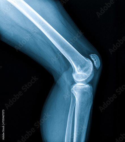 Knee joint x-ray (AP and LATERAL) view fracture and displacement of the patella bone or knee cap photo