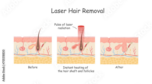 Laser hair removal of the skin layer against hair. Medical diagram before and after using laser hair removal. photo