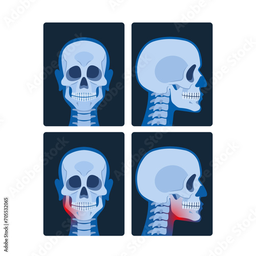 X-ray Pictures Of The Head, Or Cranial X-rays, Reveal Detailed Images Of The Skull And Brain, Aiding In The Diagnosis