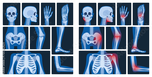 X-ray Pictures Are Medical Images Created By Exposing The Body To X-rays, Revealing Internal Structures For Diagnosing