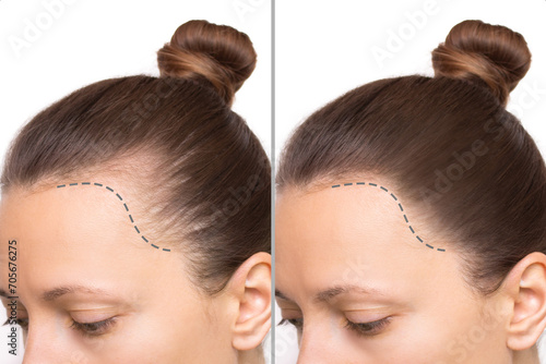 Cropped before and after head shot of a young woman with bald patches on her forehead and temples. Baldness. Close-up, side view. Hair care and treatment concept. Hair loss, hair extensions, alopecia photo