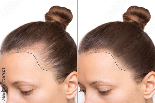 Papier peint Cropped before and after head shot of a young woman with bald patches on her forehead and temples