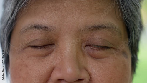 Close up of the senile cataract during eye examination. A white cloudy disc is seen in black eye circle, mature cataract, nuclear sclerosis cataract. Close up half face view photo