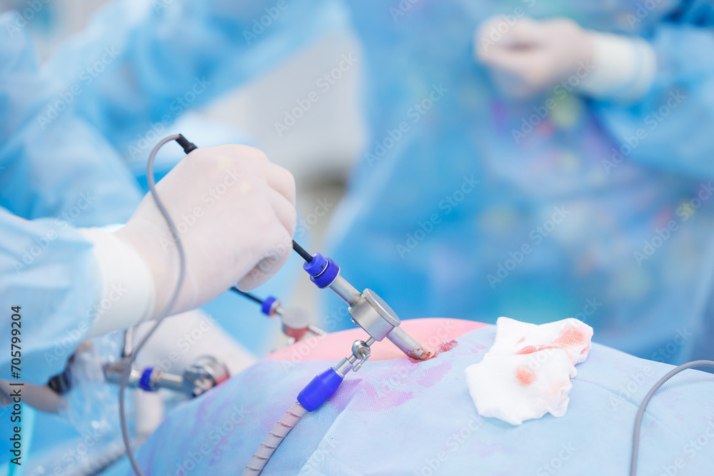Team doctors use medical instrument for laparoscopic cholecystectomy stomach, operating room